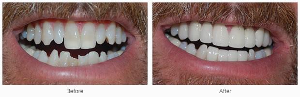 Cosmetic Dentistry with Porcelain Crowns
