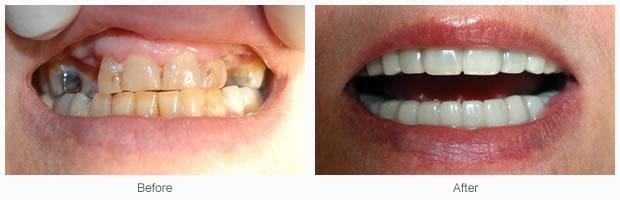 Mother of the bride with no time for dental work loved her Snap on Smile!