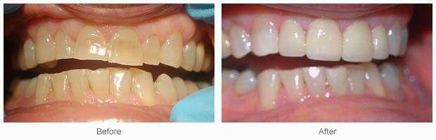 Dental Teeth Whitening and Cosmetic Porcelain Crowns