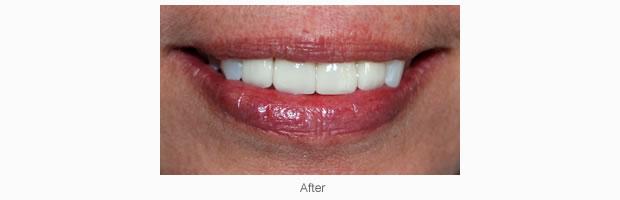 A bright new look for existing natural teeth can be achieved with Porcelain Veneers