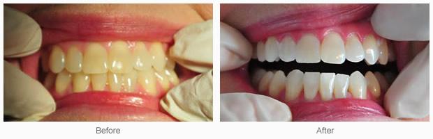 ZOOM!® Teeth Whitening